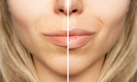 Dermal Fillers Before and After Photos: How to Evaluate Results Safely