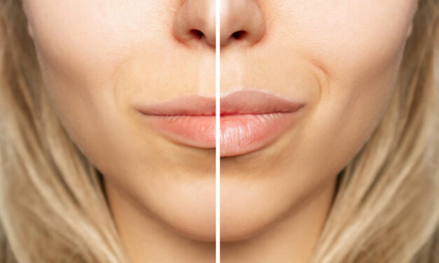 Dermal Fillers Before and After Photos: How to Evaluate Results Safely