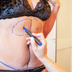 Liposuction Techniques Explained: How Approaches Differ