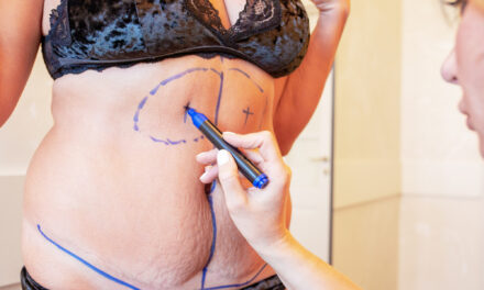 Liposuction Techniques Explained: How Approaches Differ