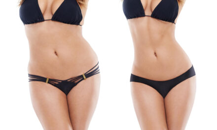 Mommy Makeover Before and After Photos: How to Evaluate Results Safely