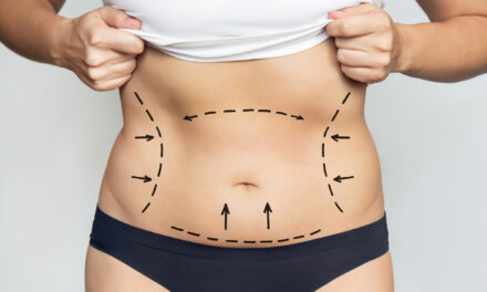 Mommy Makeover: Complete Guide to Cost, Recovery, Risks & Results