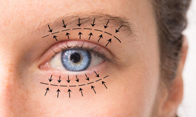 Eyelid Surgery (Blepharoplasty) Risks and Complications: What Patients Should Know